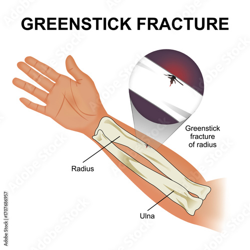 Greenstick Fracture Bone Flashcard Illustration