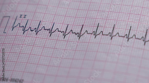Heart rhythm chart and cardiac examination by a cardiologist.
Paper electrocardiogram macro video.
A weak and diseased heart, heart rhythm in a patient in the hospital.
Resuscitation and cardiology