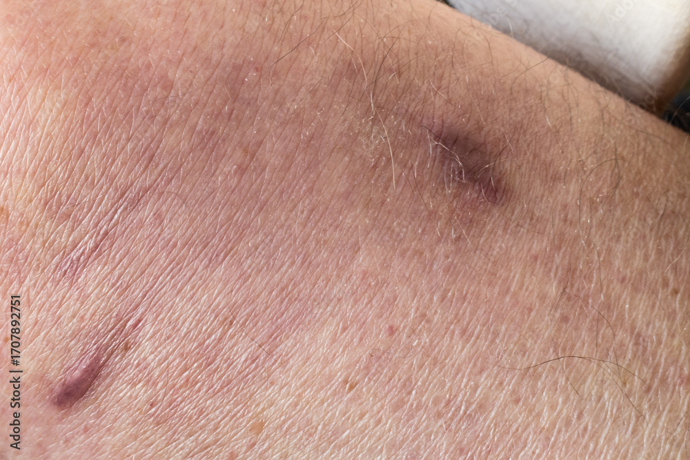 Fototapeta premium Healed wounds on the human skin after surgical removal of an abscess.