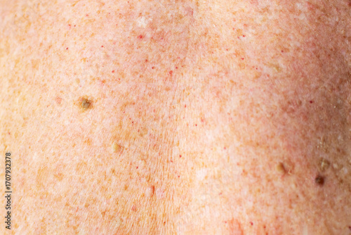 Senior woman with moles, papillomas and pigmentation spots on her back, skin cancer, malignant tumor prevention, health care, oncology risk, dermatology disease.