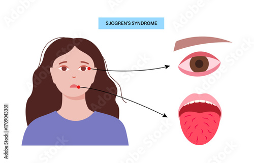 Sjogrens syndrome disease