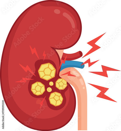 Kidney stone pain illustration medical health concept vector