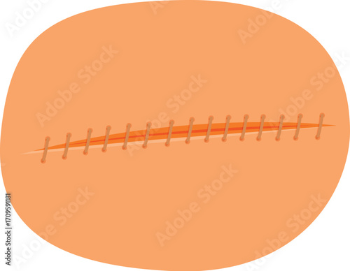 Skin scar with surgical sutures closing wound after medical procedure