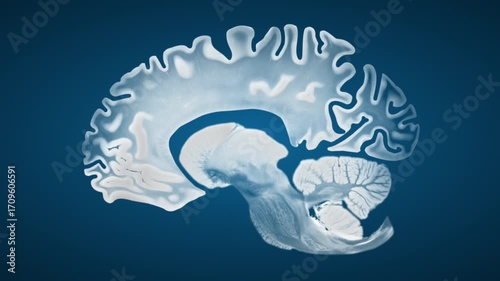 Sagittal brain visualization highlighting cortical thinning and ventricular enlargement in Alzheimer disease, presented on a blue background to emphasize structural neurodegeneration.