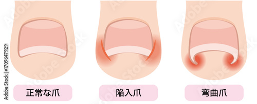 巻き爪・陥入爪・弯曲爪