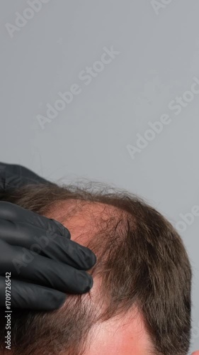 Doctor in black gloves examining male scalp with thinning hair and bald spot, concept of alopecia, hair loss diagnosis, and trichology healthcare. Vertical video.