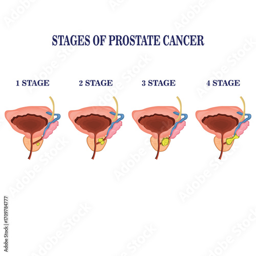 Medical diagram of 4 stages of prostate cancer. tumor grows and penetrates into neighboring organs and tissues. From small tumor to affected bladder vector illustration. . Vector illustration