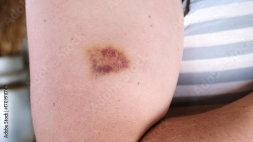 The bruise on skin close-up view. Various shades of healing process. Dark purple and yellow bruising colors on white skin. The violence concept. The consequences of injury. High quality 4k footage