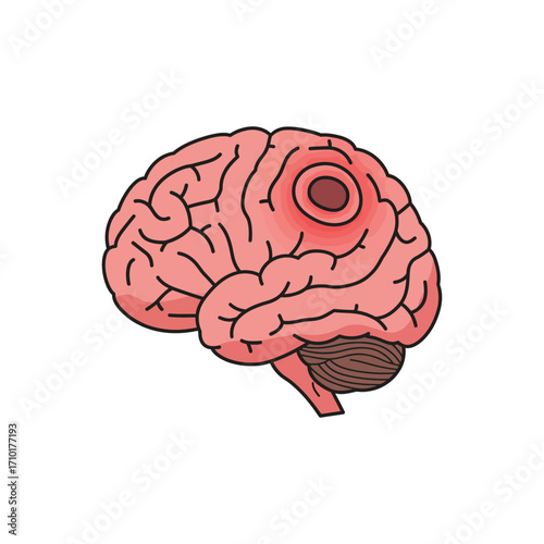 brain tumor illustration showing damaged tissue and brain health complications for medical content