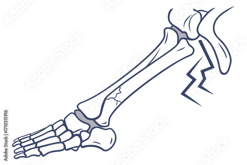 Illustration of a fractured tibia and fibula bone in the lower leg and ankle