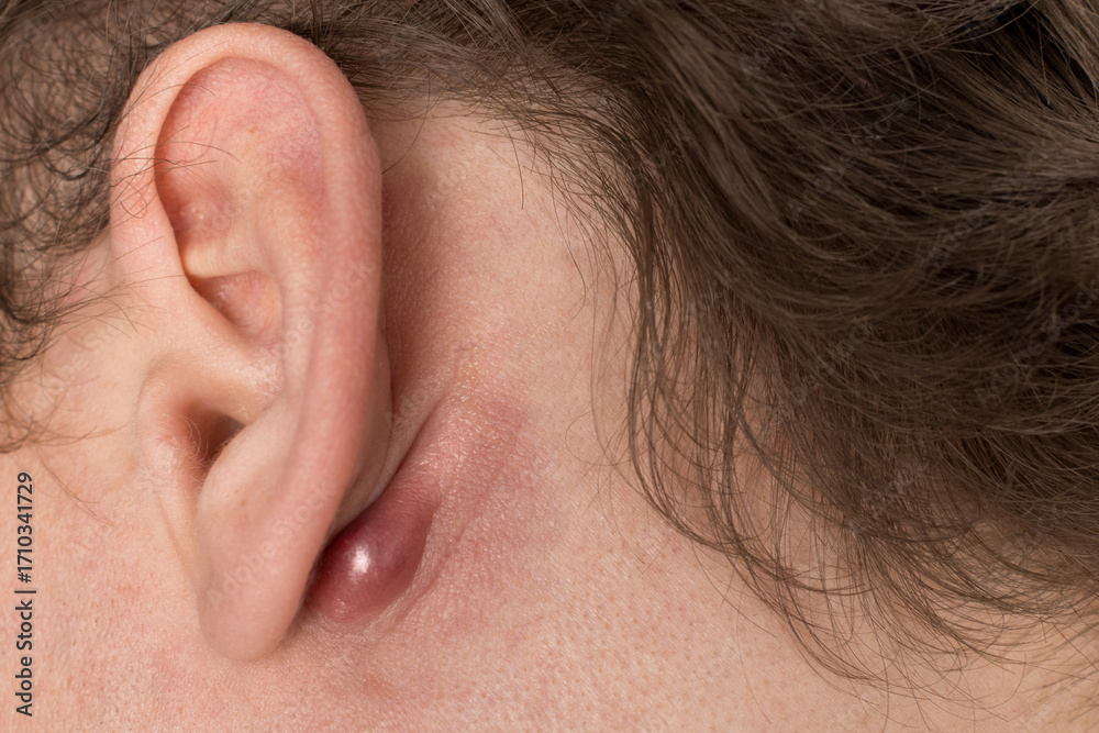 Φωτογραφία Close-up of an inflamed, swollen red lump located on the skin behind a person's ear, suggesting a dermatological condition