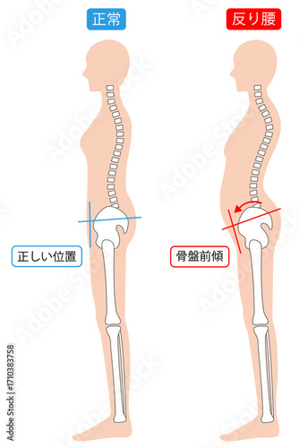 反り腰と正常な姿勢の女性　背骨と骨盤