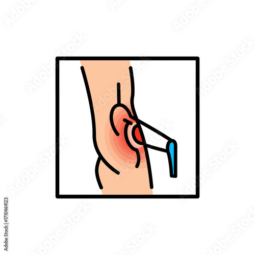 knee injection illustration showing medical procedure against knee pain and osteoarthritis for medical content