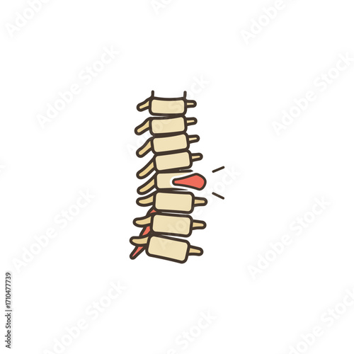 herniated disc illustrating spinal compression causing pain ideal for medical education materials