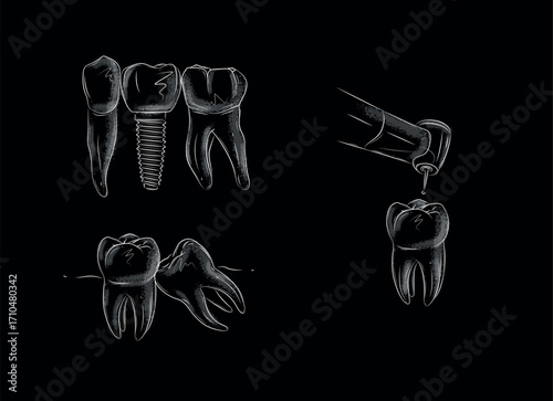 Drill the tooth with dental machine, implant, remove sick teeth illustrations drawing in graphic style with white on black background.