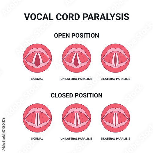 Vocal cord (vocal fold) paralysis: comparison of normal, unilateral, and bilateral paralysis with positions in breathing and phonation. Voice, breathing, and swallowing disorders. Medical vector.