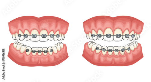 Detailed orthodontic apparatus on upper and lower teeth
