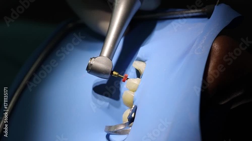 Dental handpiece with rotary file inserted into a tooth during root canal treatment under rubber dam isolation. Concept of endodontics, precision work, and patient care.