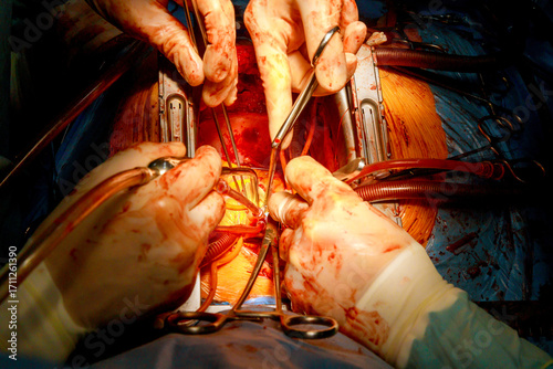 Surgeons carefully work on patients heart, showcasing teamwork, precision within bright operating room.