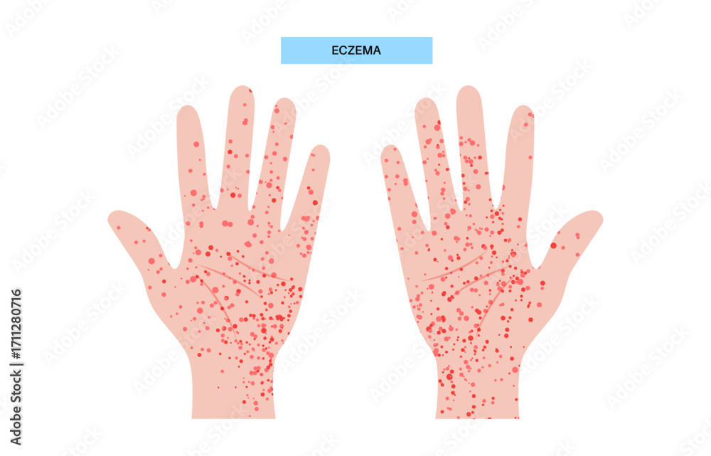 Obraz premium Eczema medical poster