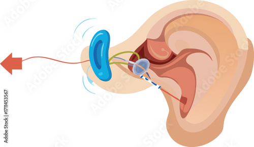 Illustration of a hearing aid, showcasing its design and features for enhancing auditory perception.
