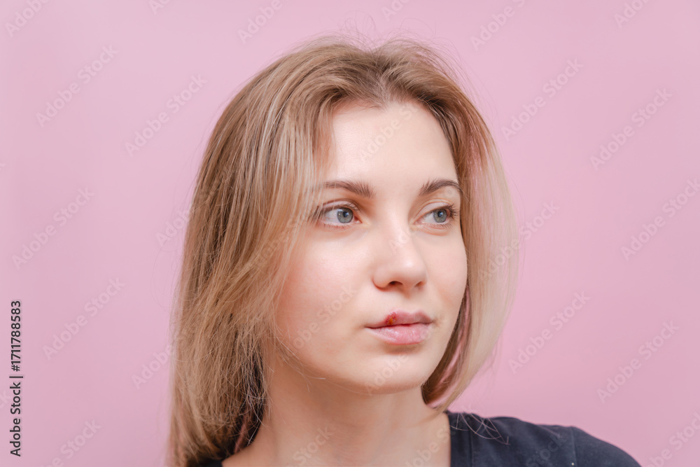 Fototapeta premium Young woman with virus herpes on lips against pink background. Herpes blisters