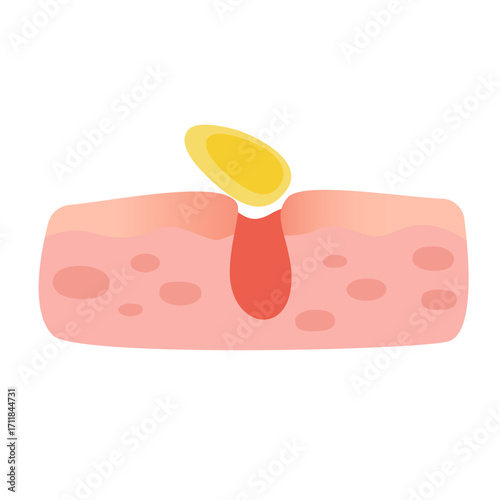 Acne facial type concept. vector illustration