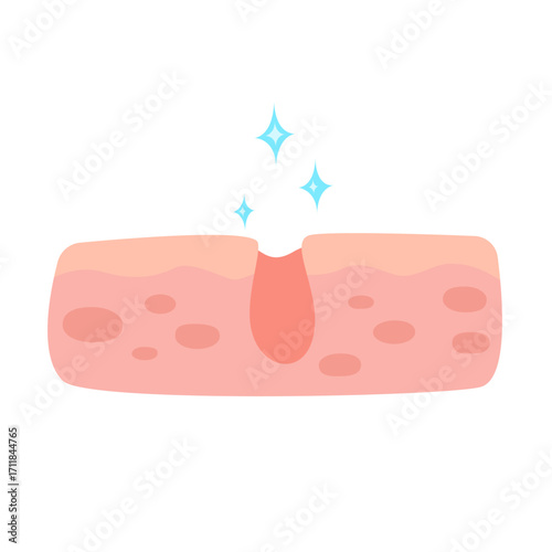 Acne facial type concept. vector illustration
