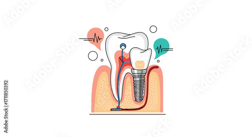 Understanding the dental implant process and root canal treatment.