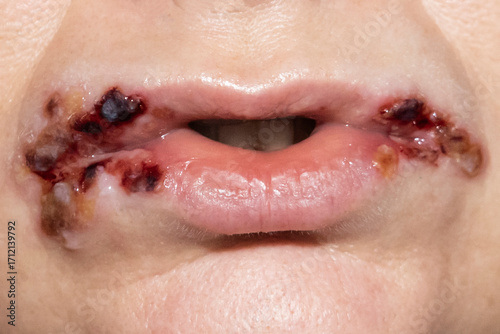 Infection on lips. Crack in the corner of the mouth, sores around the mouth, sore on the lips with dry blood on the woman face.