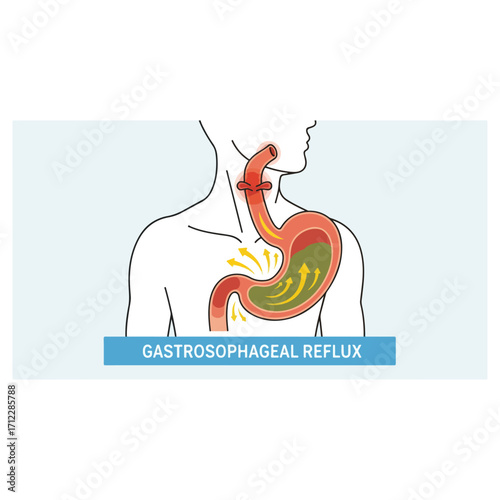 Gastroesophageal Reflux Disease Medical Illustration Depicting Stomach.