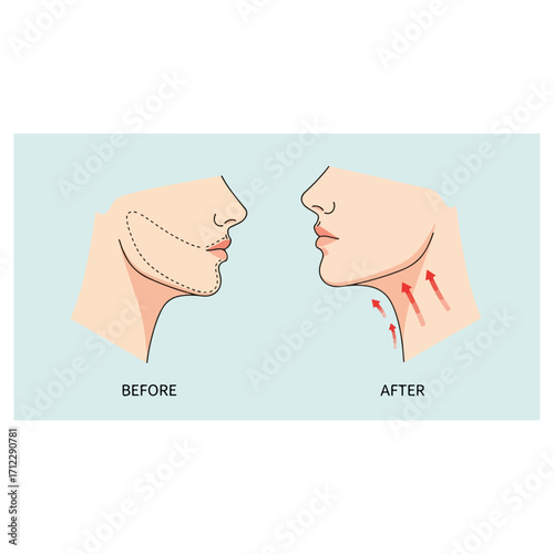 Facelift Procedure - Before and After Comparison Depiction.