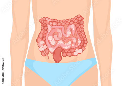 Woman suffering from abdominal bloating showing her swollen intestine