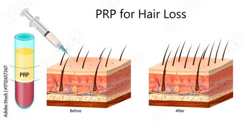 PRP Therapy for Hair Loss Before and After Illustration. Platelet Rich Plasma Injection for Hair Regrowth Diagram. Treatment for Scalp and Hair Follicles