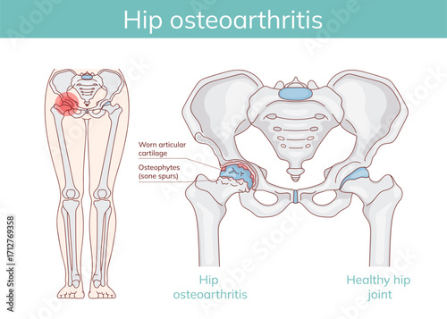 Hip Osteoarthritis vs. Normal Joint – Medical Illustration of Degenerative Changes