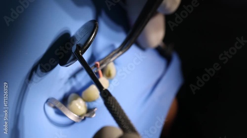 Close-up of endodontic treatment with dental file inside root canal, isolated by blue rubber dam. Concept of modern root canal therapy and precision dentistry.