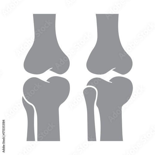 Bone Joint Illustration