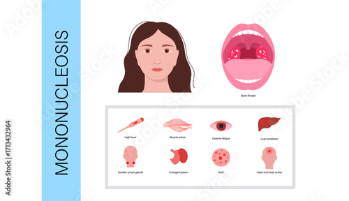 Mononucleosis symptoms poster