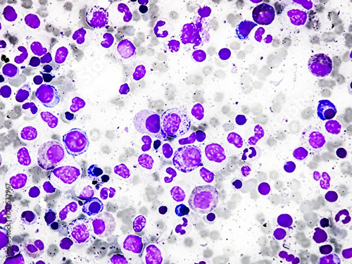 Bone marrow study: Suggestive of Erythroid hyperplasia