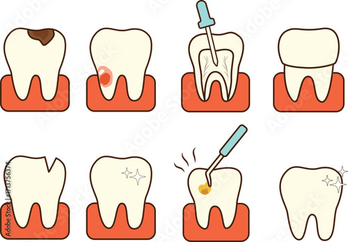 Tooth Decay and Dental Treatment Process – Cavity Filling and Root Canal Illustration