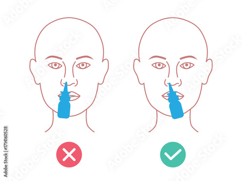 Proper use of a nasal spray. Medical infographic. Tilt head slightly forward, aim nozzle away from the septum, inhale gently while spraying, then wipe and recap. For patient education, pharmacies