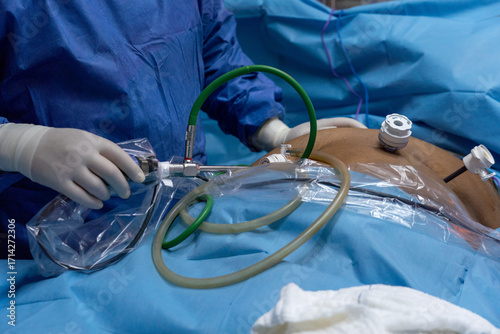 gastric sleeve surgery performing by surgeon