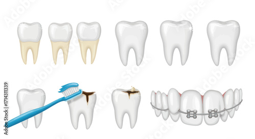 Stages of Tooth Decay and Dental Care Illustrated.