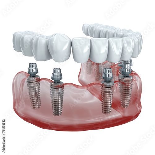 3D Render of All-on-4 Dental Implants