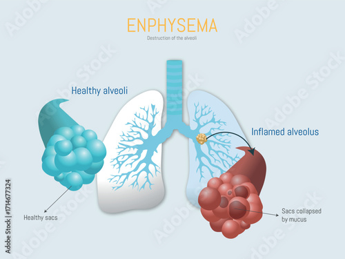 Emphysema destroying alveoli, showing healthy and inflamed lung sacs