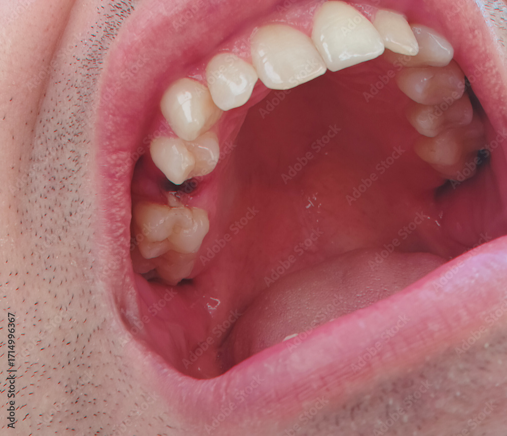 Obraz premium open mouth of a man with the place of pulled out small molar tooth, healing of a wound in the place of the tooth.