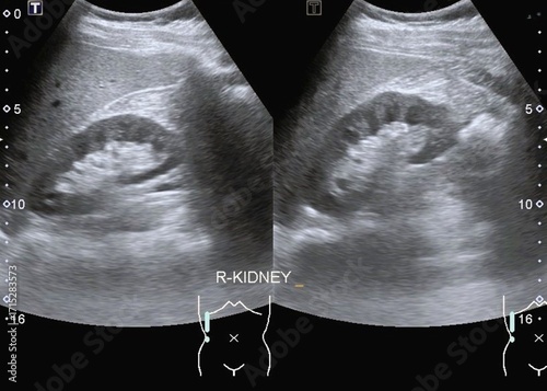 Photos ultrasonography normal kidney 
normal renal anatomy