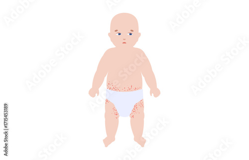 Diaper rash poster