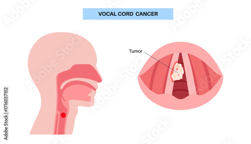 Vocal cord cancer medical poster