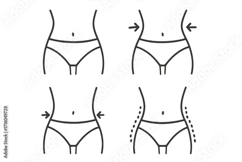 Weight loss line icon set. Body contouring, slimming concept. Woman waist before and after diet, liposuction. Female figure transformation. Fat removal plastic surgery vector.